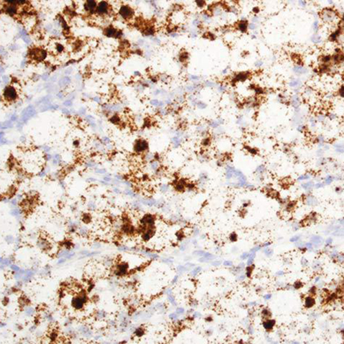 Biomarker Could Help Identify Difficult-to-Diagnose Kidney Cancer Subtype