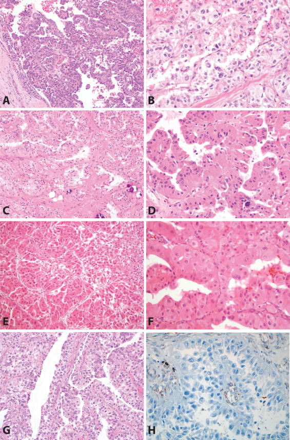 Caption: Figure 1.0 - Differential diagnosis for type 2 papillary renal cell carcinoma