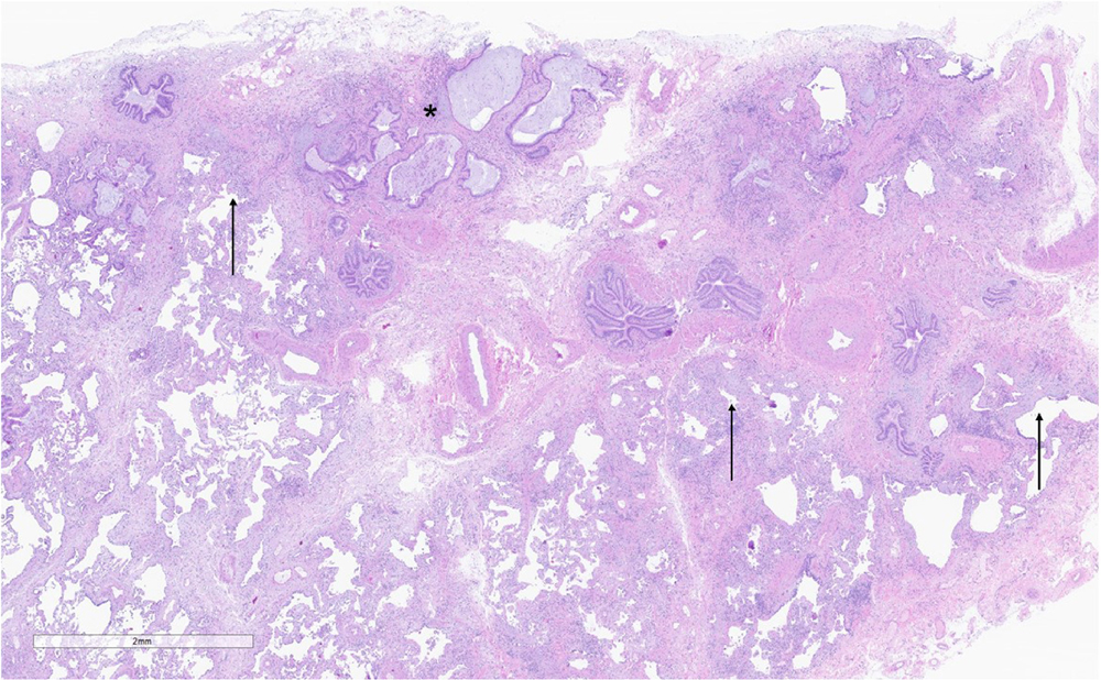 Cases diagnosed as definite usual interstitial pneumonia showed a characteristic pattern of “patchwork” fibrosis, comprised mainly of dense collagen deposition with scattered fibroblastic foci (arrows). The fibrosis resulted in architectural distortion in the forms of both scarring and microscopic honeycomb change (asterisk).