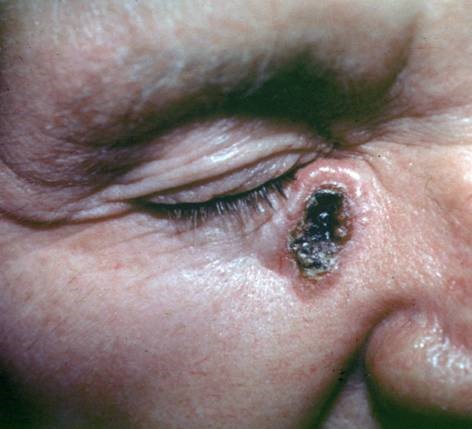 An example of Basal Cell Carcinoma